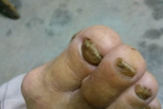 灰指甲最开始的症状会发脓吗